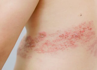 Pharmacists soon to provide shingles management