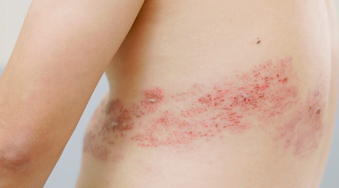 Pharmacists soon to provide shingles management