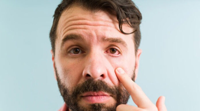 Conjunctivitis – an irritating condition