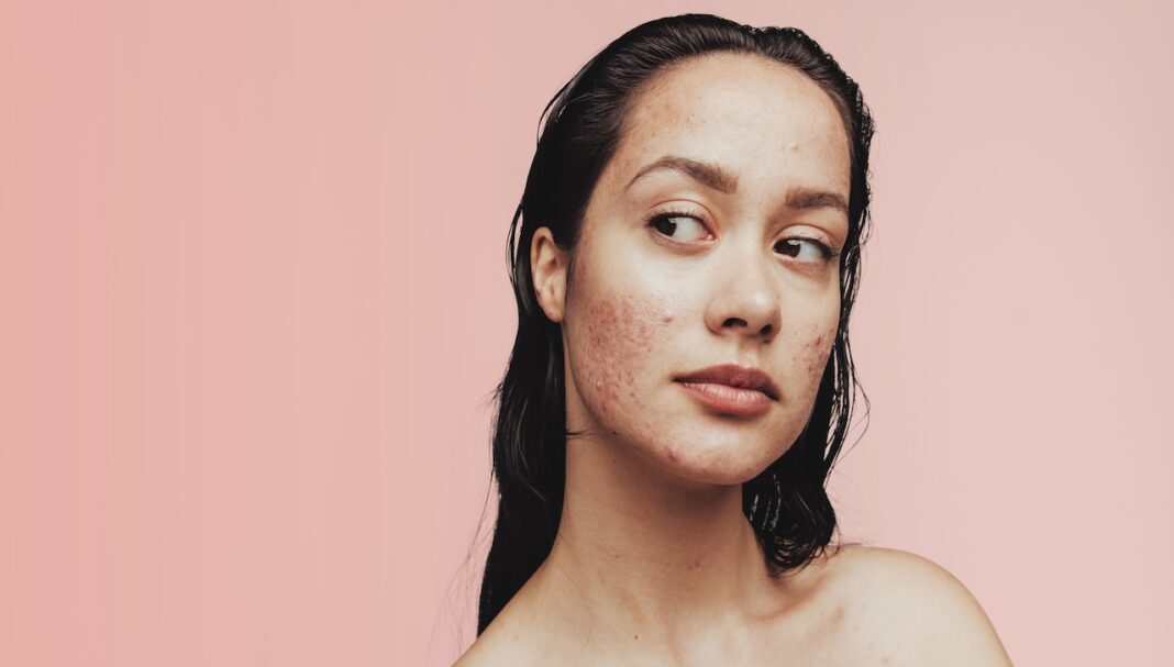 Close up of woman with acne inflammation