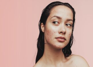 Topical adapalene for acne vulgaris