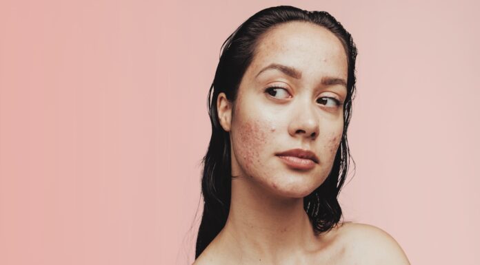 Topical adapalene for acne vulgaris