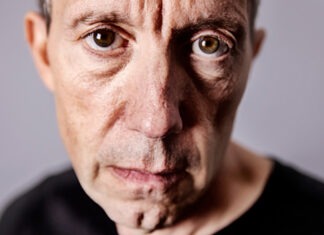 Age-related macular degeneration