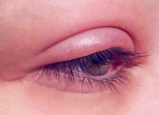 Blepharitis causes and management