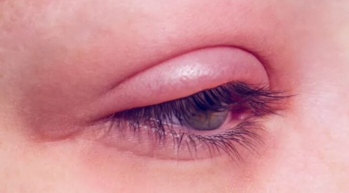 Blepharitis causes and management