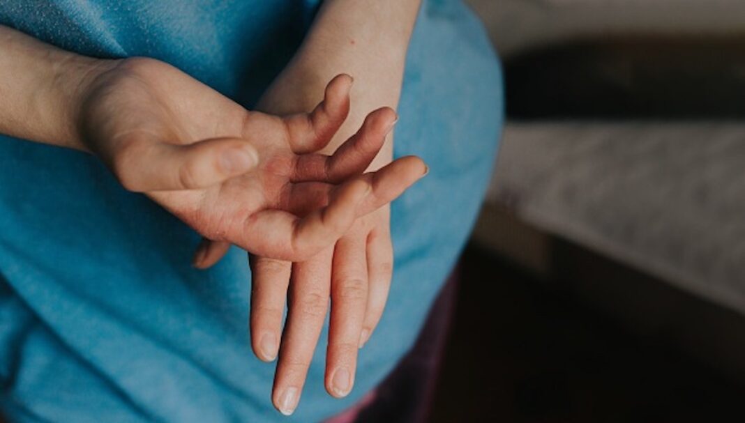 Woman sick hands. Scabies in hands
