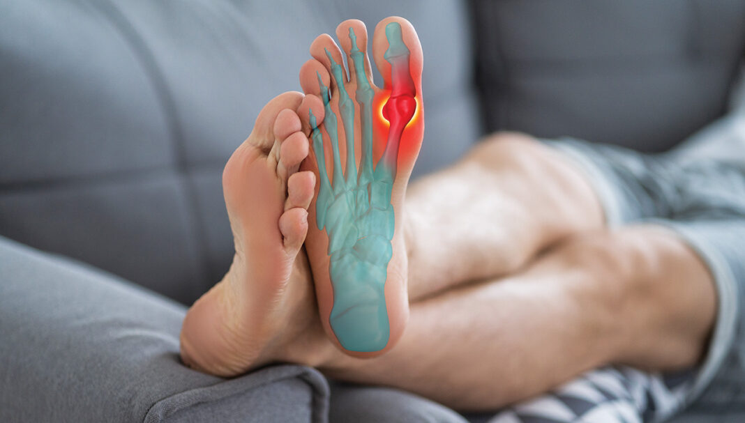 gout-management-GettyImages-1357527484