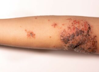 Impetigo: a brief overview