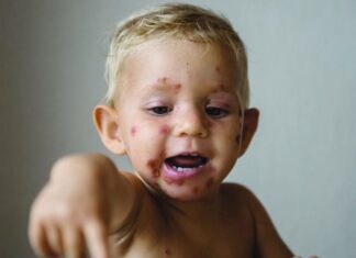 Pharmacy prescribing trial expands to include skin conditions