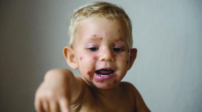 Pharmacy prescribing trial expands to include skin conditions