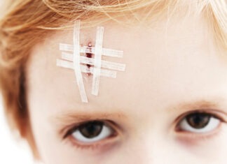 The management of acute wounds commonly seen in community pharmacy