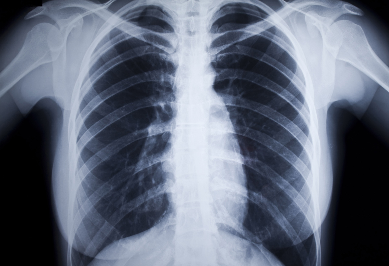 COPD WEB 2 x-ray of chest