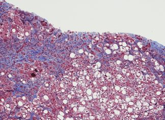 Hepatitis C deaths fall sharply but cure access dropping