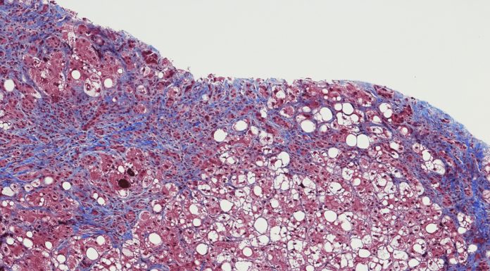 Hepatitis C deaths fall sharply but cure access dropping