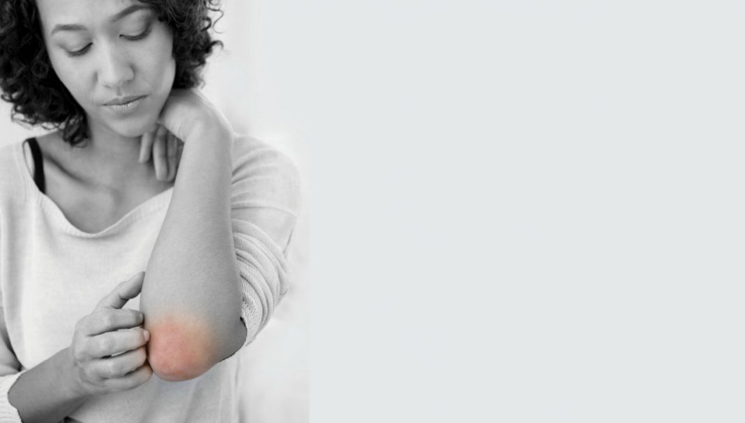 82-83_PSA10_EVDSUM eczema