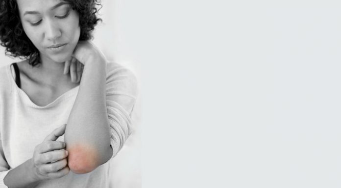 The effectiveness of probiotics for the treatment of eczema eczema