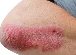 New PBS listing could change psoriasis treatment PBS