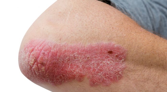 New PBS listing could change psoriasis treatment PBS