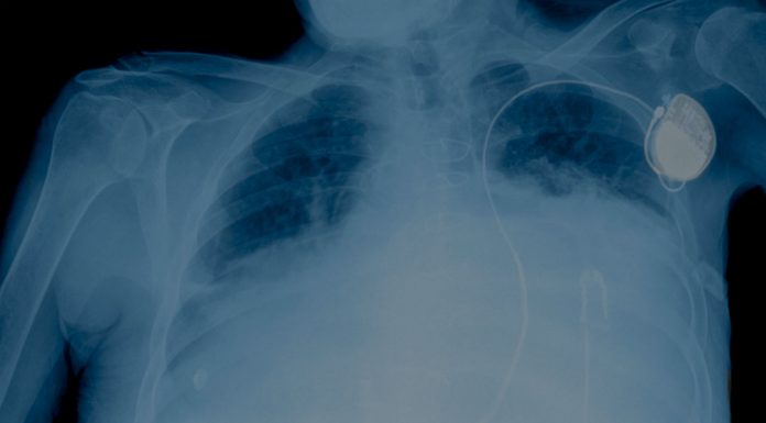 Systemic corticosteroids for dyspnoea corticosteroids