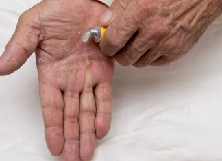Atopic dermatitis may spike in older adults: report atopic dermatitis