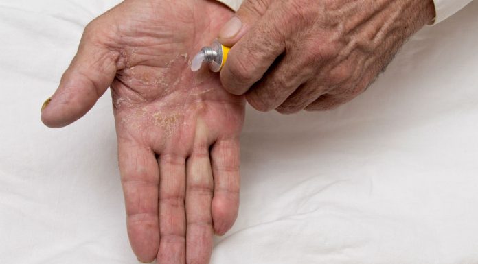 Atopic dermatitis may spike in older adults: report atopic dermatitis