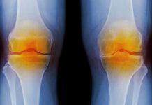 Relieve the pain and inflammation of osteoarthritis with Nurofen osteoarthritis