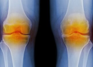 Relieve the pain and inflammation of osteoarthritis with Nurofen osteoarthritis