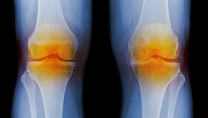 osteoarthritis osteoarthritis