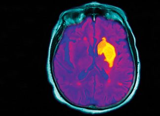 Stroke management in 2020