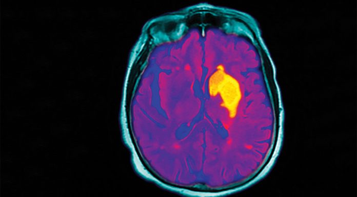 Stroke management in 2020
