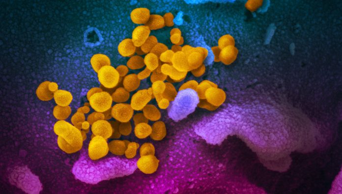 COVID-19-NIAID-RM-feature A scanning electron microscope image shows SARS-CoV-2 (yellow) – also known as 2019-nCoV, the virus that causes COVID-19 –isolated from a patient in the US, emerging from the surface of cells (blue/pink) cultured in a lab. Image: NIAID-RML