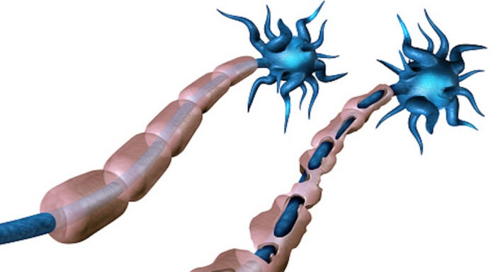 The efficacy of ocrelizumab for multiple sclerosis