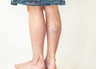 Efficacy of antiplatelets in deep venous thrombosis