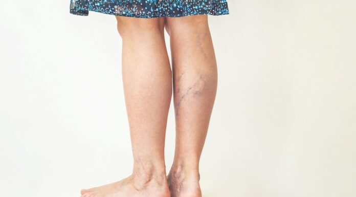 Efficacy of antiplatelets in deep venous thrombosis