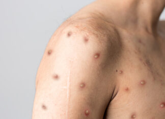 Curbing the spread as mpox cases skyrocket mpox