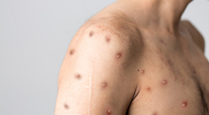 Curbing the spread as mpox cases skyrocket mpox