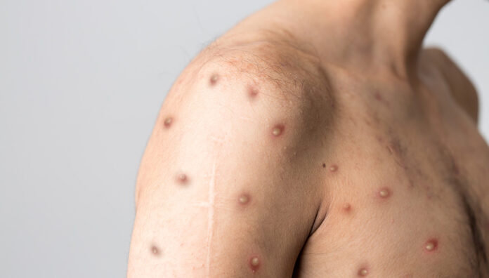 GettyImages-1399807208_web mpox