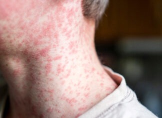Is Australia heading for a massive measles outbreak? measles