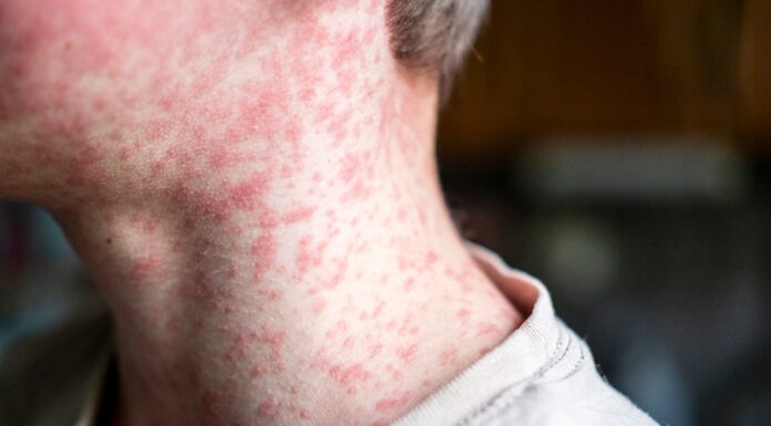 Is Australia heading for a massive measles outbreak? measles