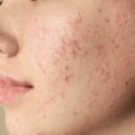 acne 1-min