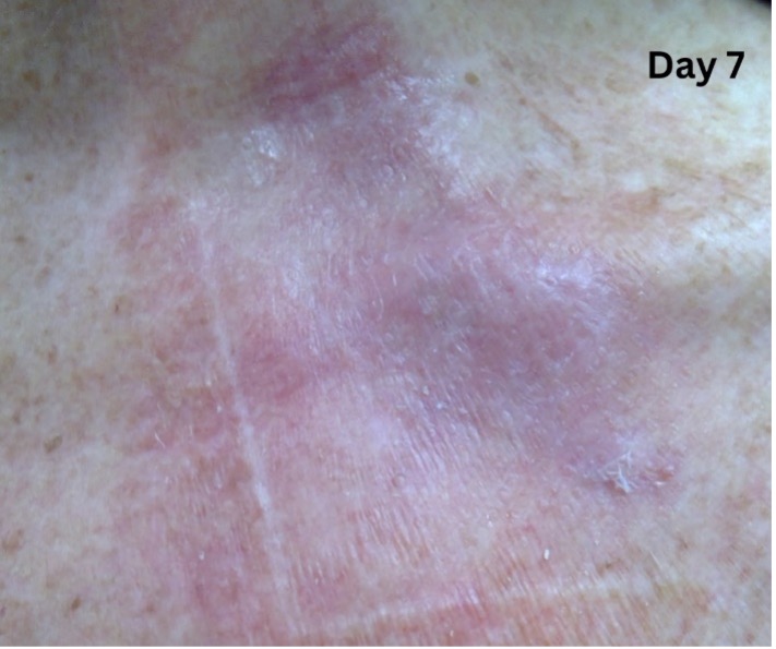 wound infection