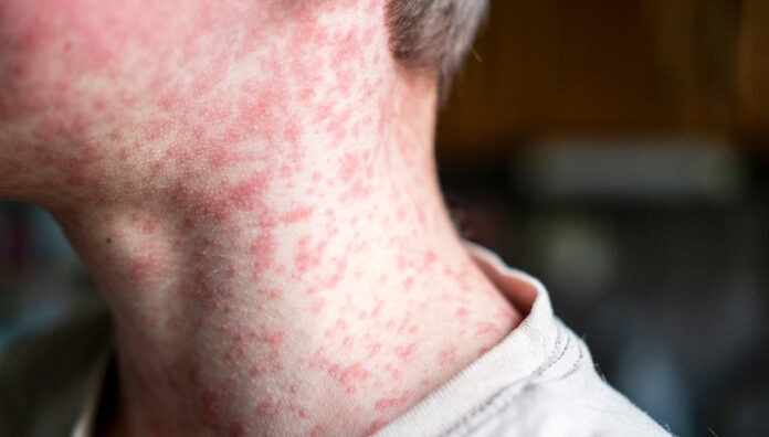 measles